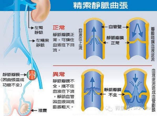 關(guān)于2021年征兵精索靜脈曲張標(biāo)準(zhǔn)的探討，2021年征兵精索靜脈曲張標(biāo)準(zhǔn)深度解析